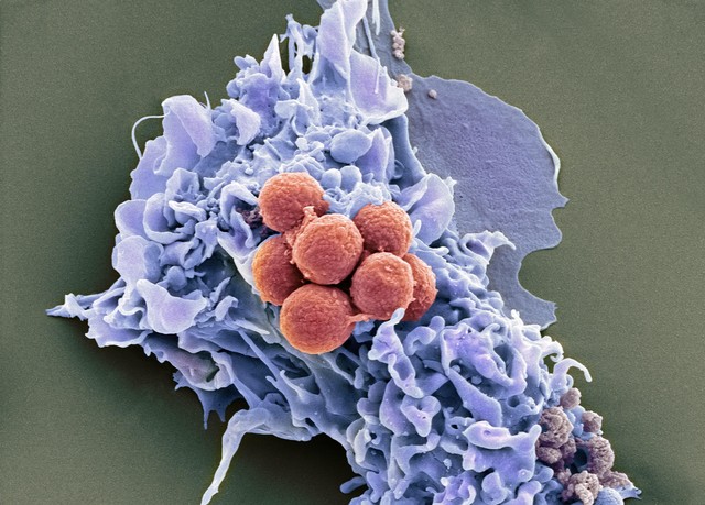 真菌感染的脚气是什么原因造成的,真菌性脚气传染又痒又肿用什么药