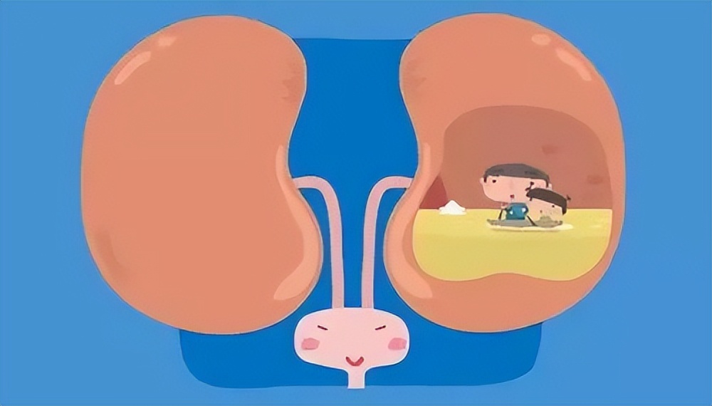 肾结石有积液怎么办,肾结石伴局限性积液