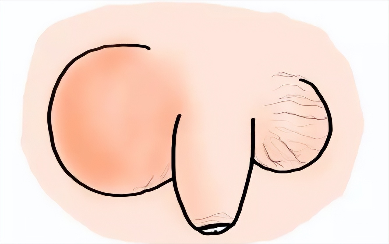 省妇幼鞘膜积液,洛阳妇幼保健院鞘膜积液微创