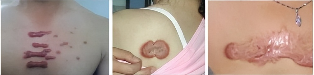 最难愈合的疤痕,无法治愈的疤痕