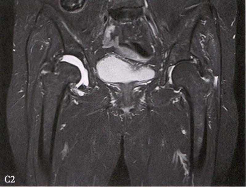全国十大股骨头坏死诊疗中心,股骨头坏死诊疗方法有哪些