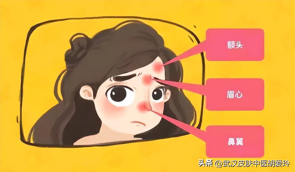 额头上长痘痘挤了之后出血,额头上长痘痘挤了有硬块变黑色的