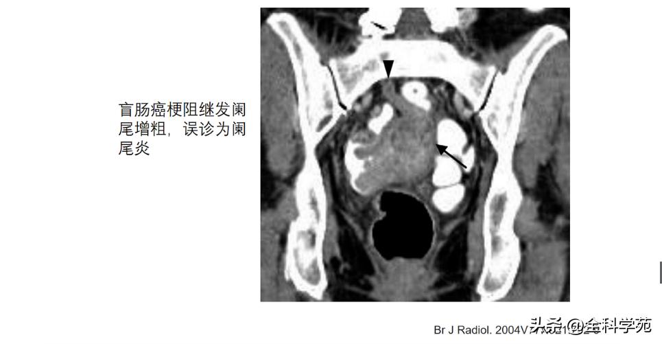 阑尾炎的讲解,关于阑尾炎的讨论总结