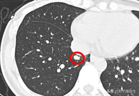 smarca-4缺陷型肺癌早期能手术吗,早期肺癌手术前一定要做petct吗