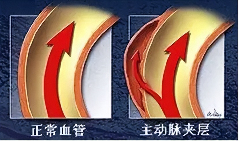 动脉夹层两侧血压相差,胸痛动脉夹层