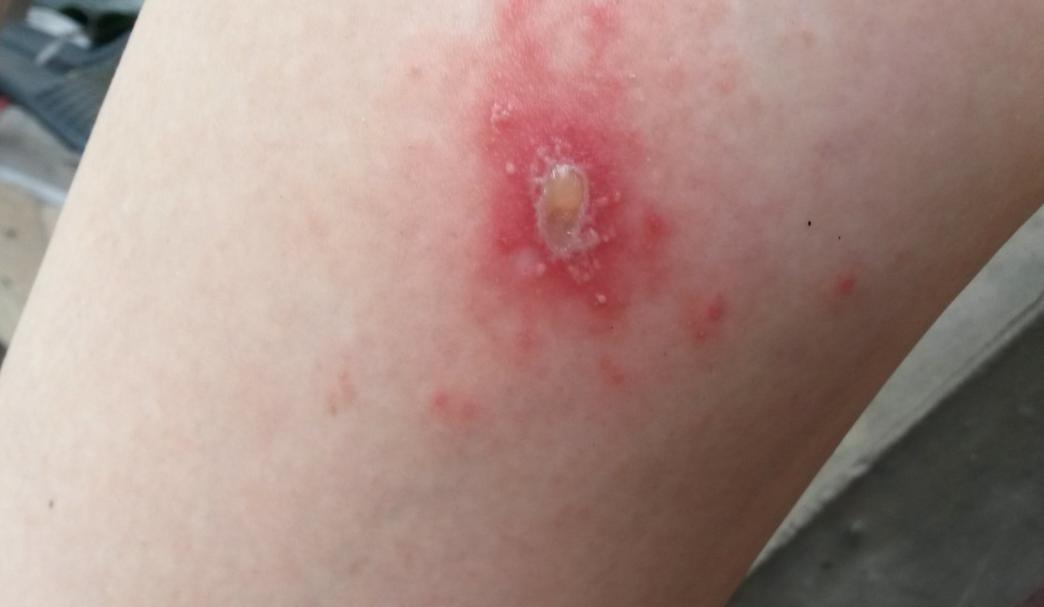 5个月宝宝皮肤破皮怎么办,5个月宝宝手臂烂