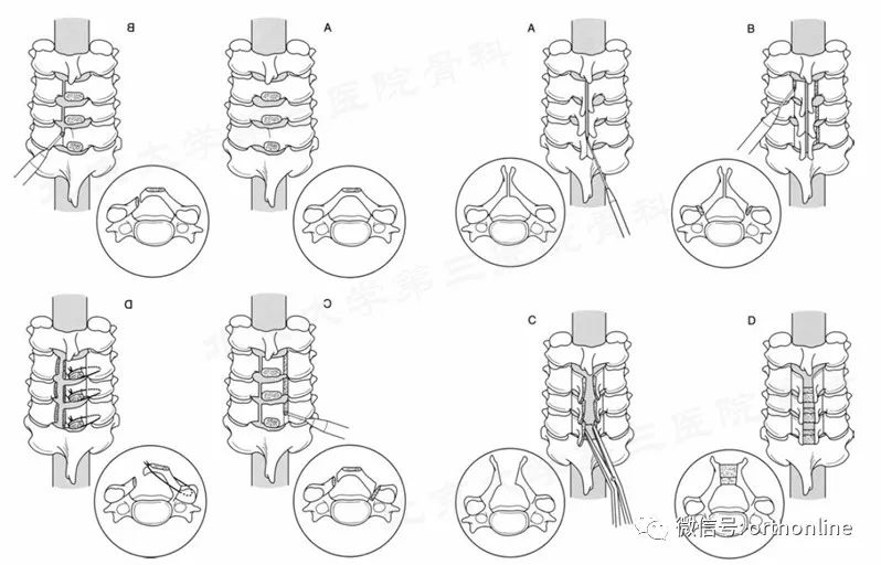 脊髓型颈椎病椎板成形术,椎间盘成形术指征