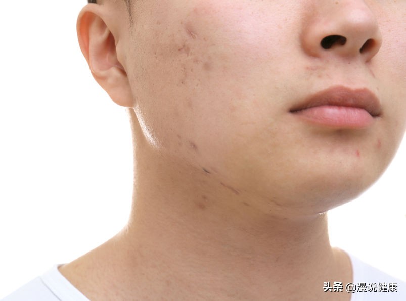 青春痘疫苗什么时候上市,青春痘要有疫苗了你会接种吗