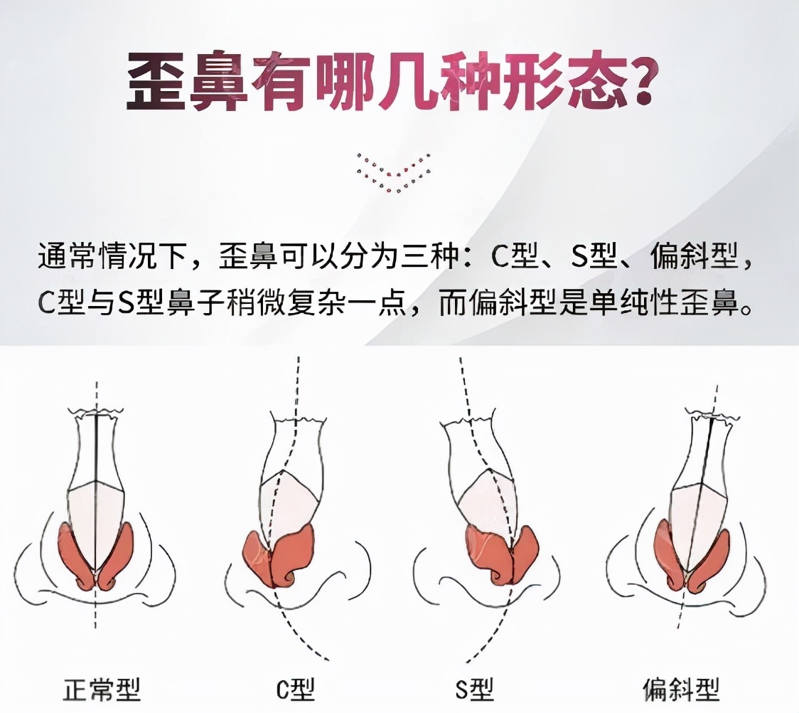 改善鼻梁歪斜的最佳方法,鼻梁不平整怎么改善