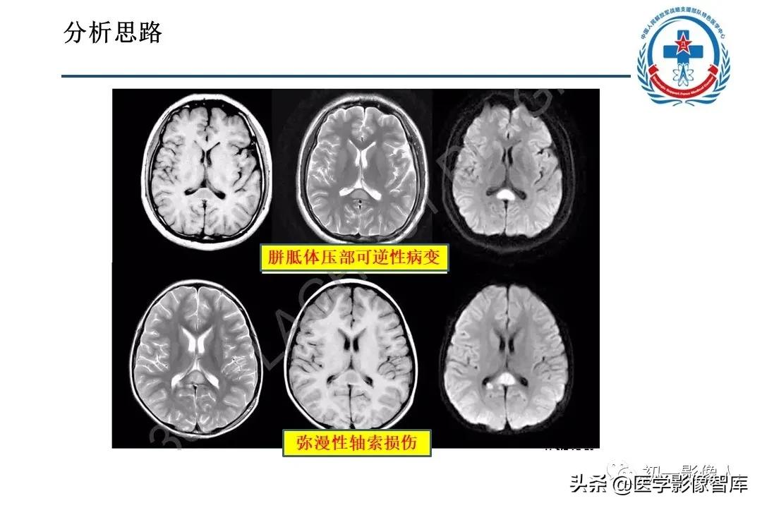 胼胝体变性治疗方法,原发性胼胝体病变治疗