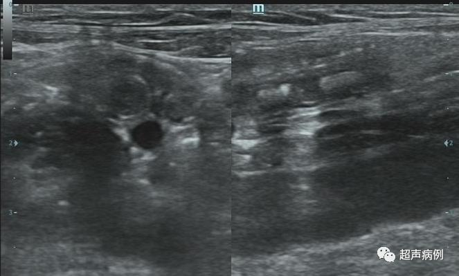 阑尾炎超声下怎么看？哪些知识需要掌握？这里都总结好了