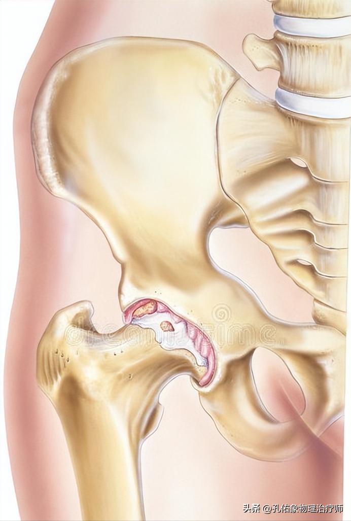 胯骨疼痛警惕四种病,身体有病是什么感觉