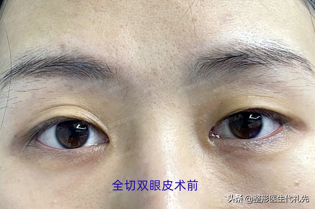 45岁全切双眼皮一月恢复过程,40岁全切双眼皮术后记录