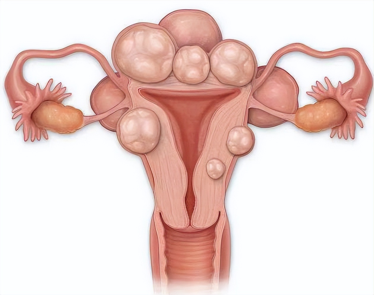女性摘掉子宫会加速变老吗,女人摘掉子宫还会排卵吗