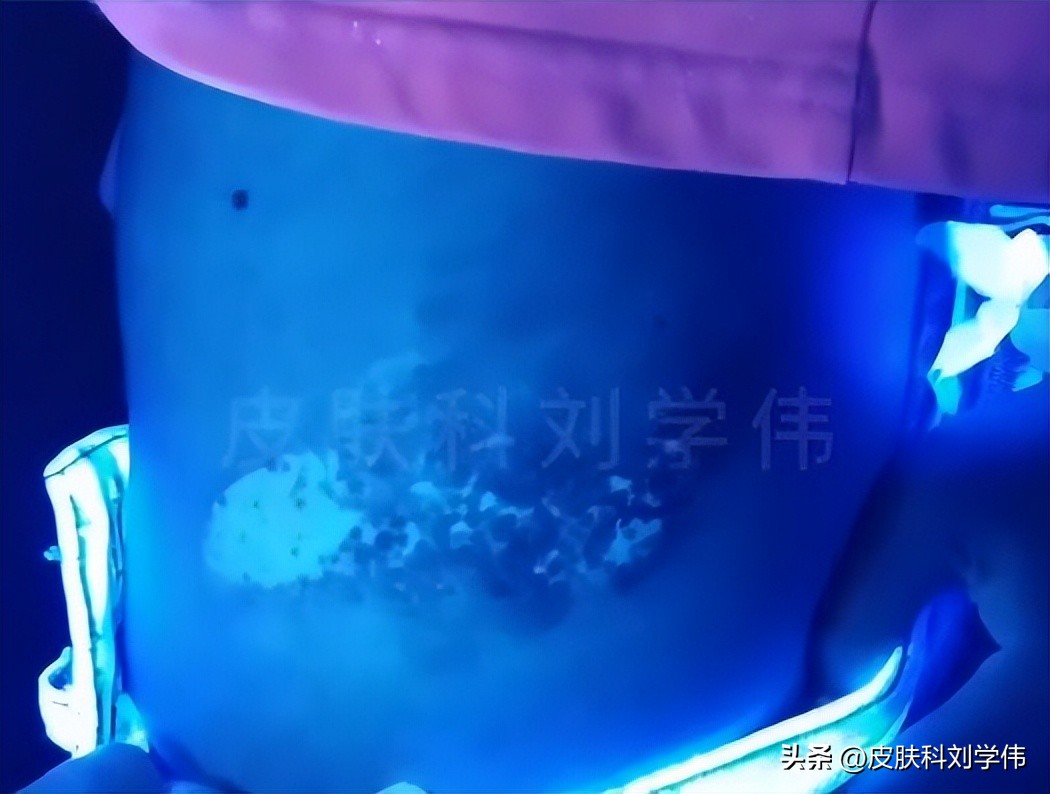 女孩长蛲虫,女子长虫