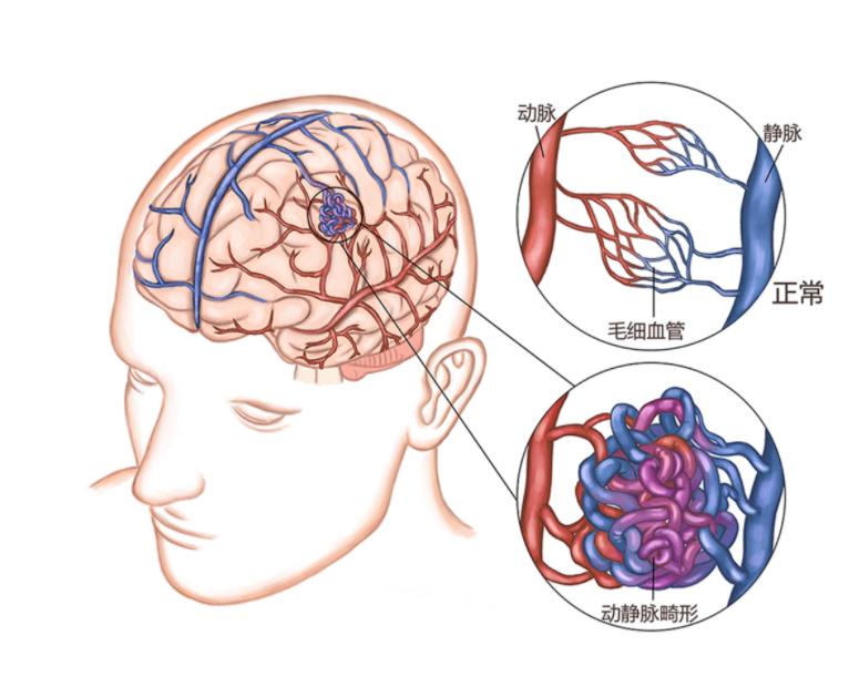 动静脉畸形算重大疾病吗,儿童动静脉畸形介入治疗