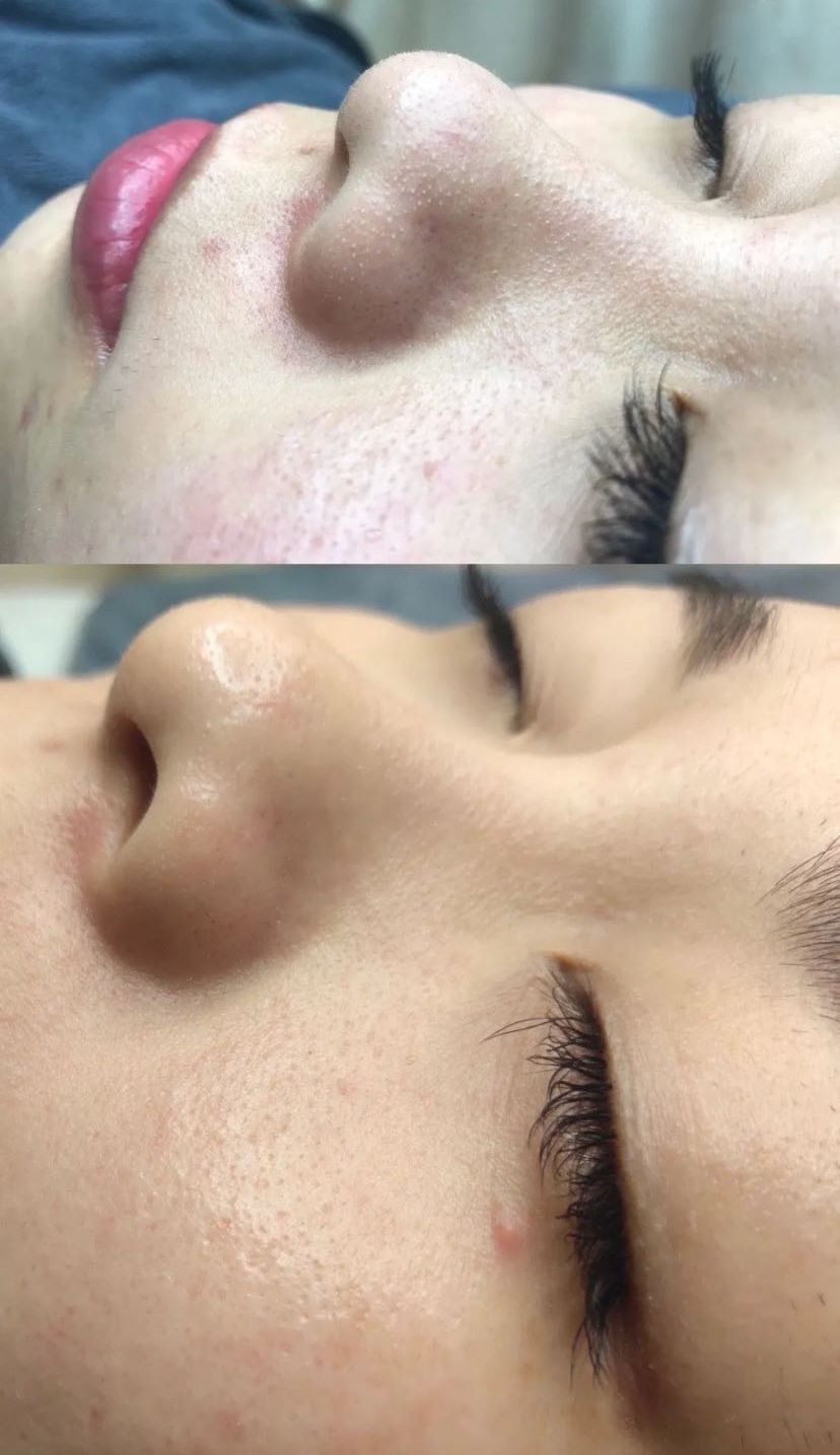 毛孔堵塞毛孔发黑怎样清理,毛孔长螨虫堵塞毛孔怎么办