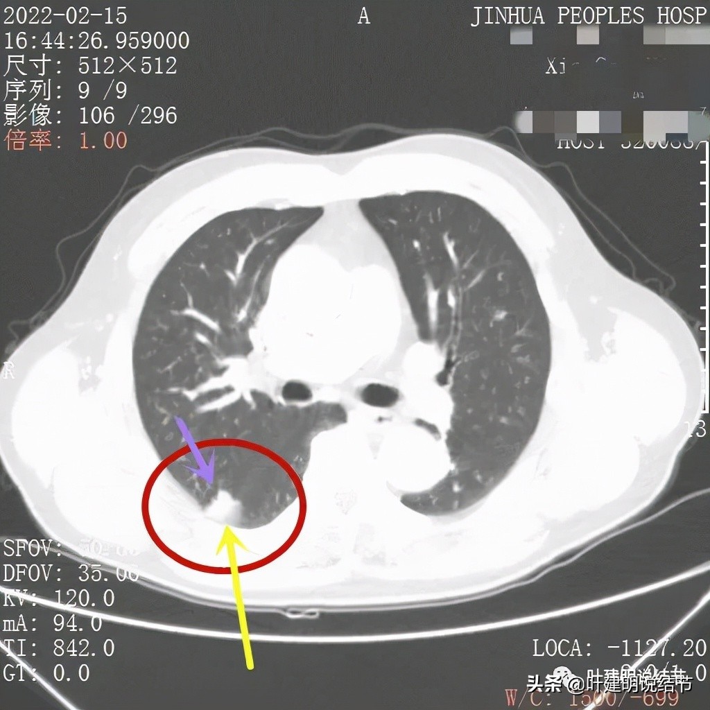 肺腺癌高危亚型什么意思,肺腺癌高危亚型