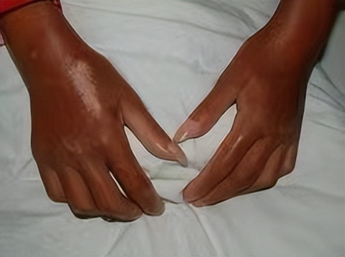 风湿免疫类疾病最怕什么,风湿免疫疾病如何预防