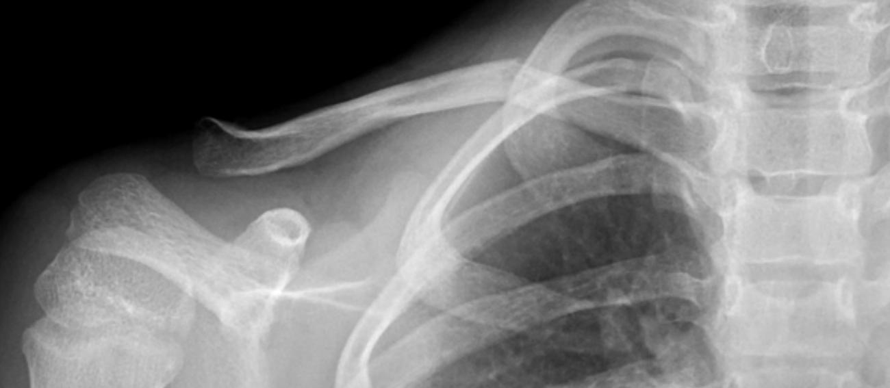 锁骨骨折吃什么食物最好,锁骨骨折怎么绑绷带视频