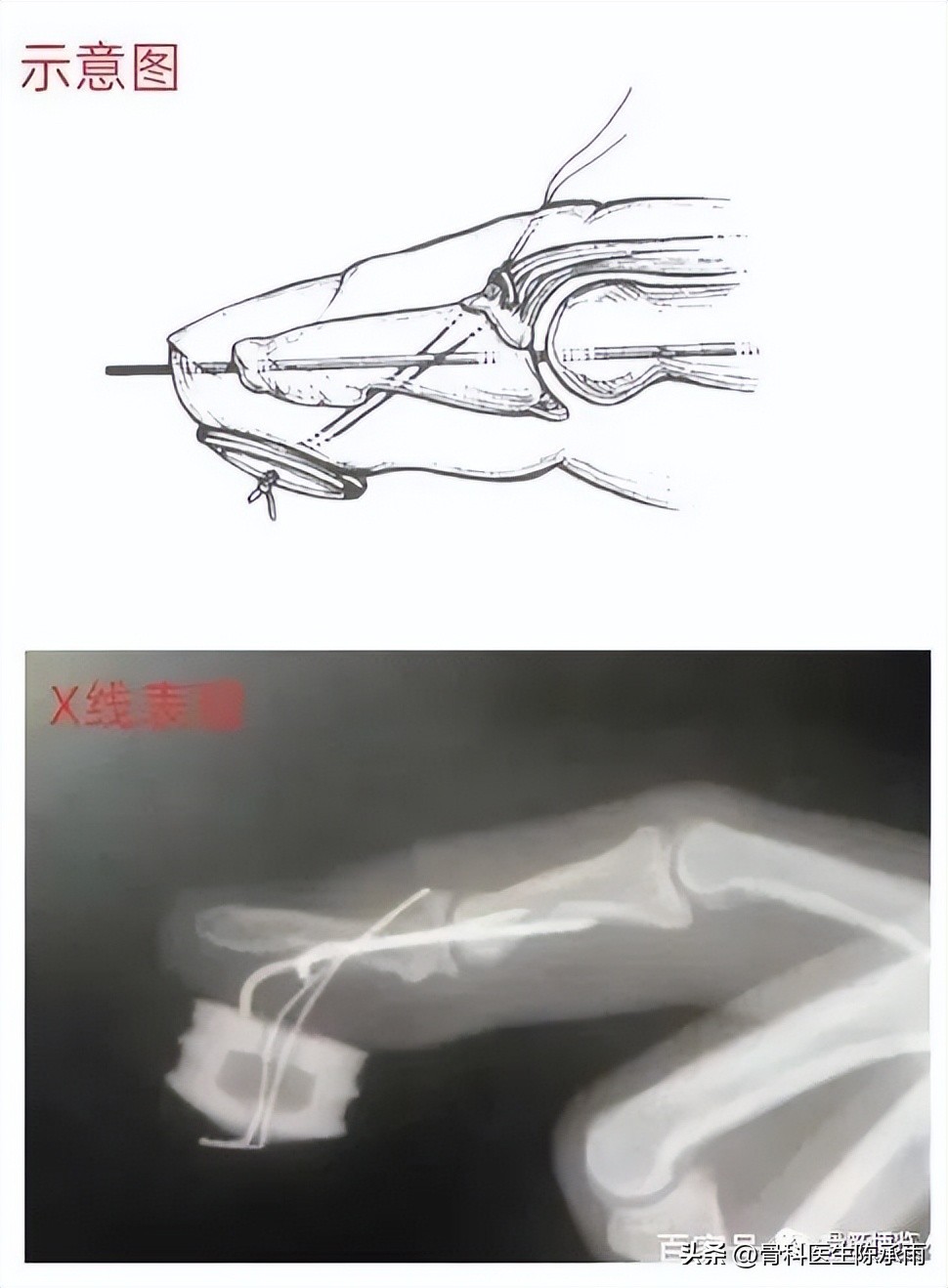 手指出现锤状畸形不要太紧张，看后知道伸肌腱止点断裂重建术