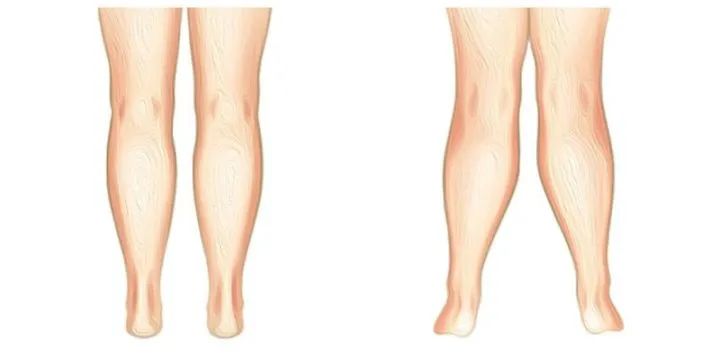 矫正x型腿最快的方法,孩子的x型腿如何矫正