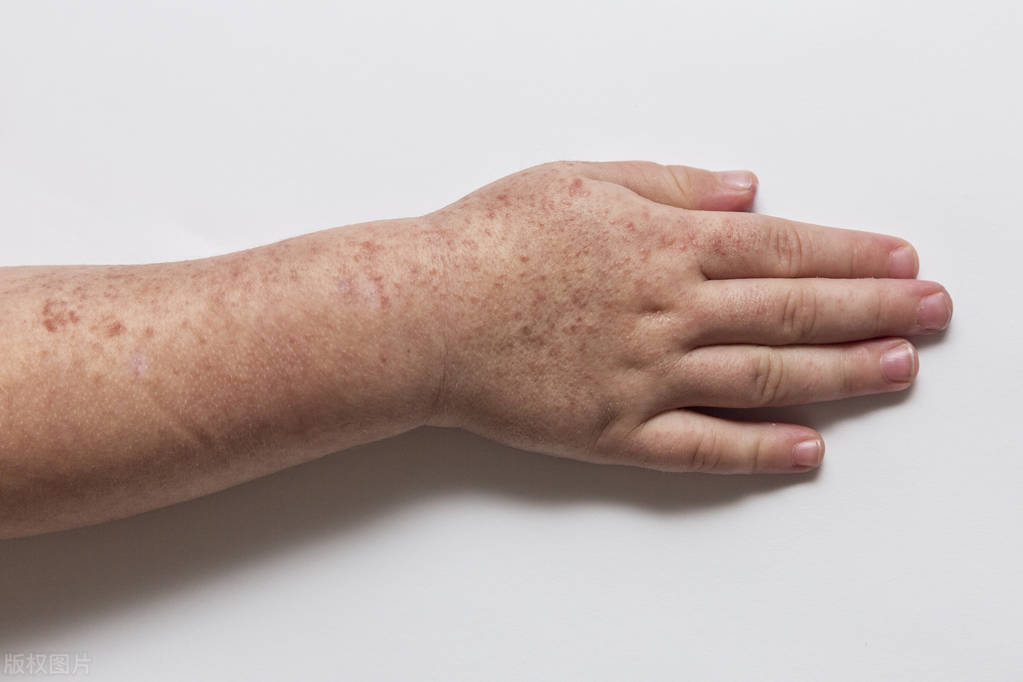 感染hpv身上会有小红点点怎么治疗,手背上冬天起密密麻麻小红点是hpv