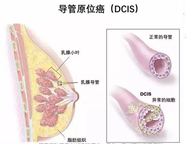 联合检查达到的效果,合并导管原位癌