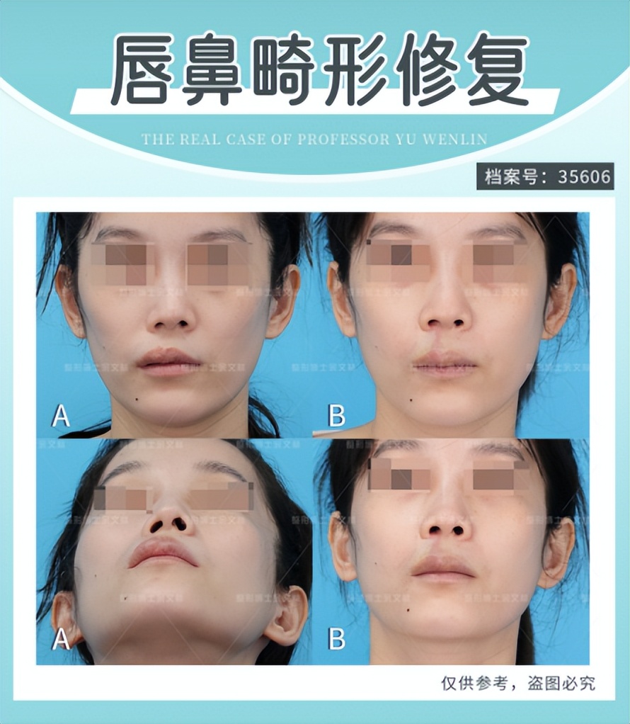 如何判断鼻畸形修复有没有成功？