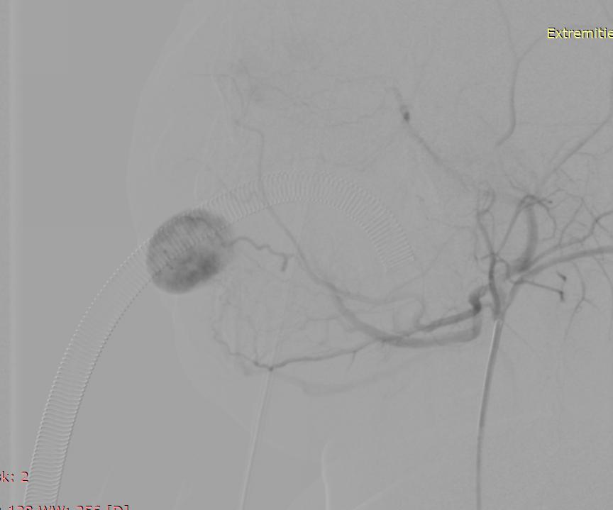 唇血管瘤,嘴唇血管瘤介入治疗过程