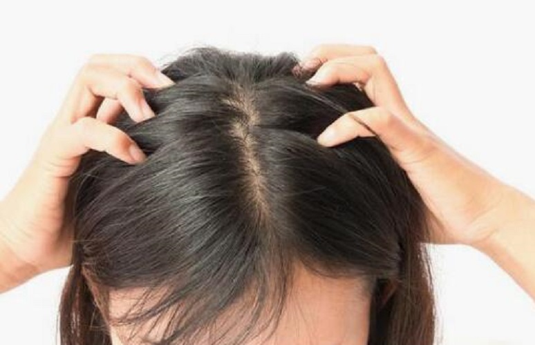头发油多头皮发痒是什么原因,头发掉得厉害头皮发痒怎么回事