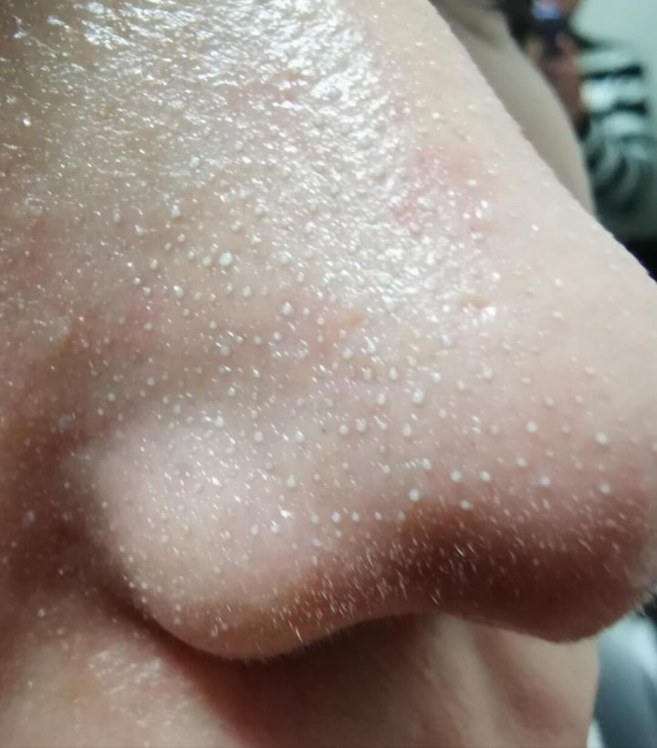 超微小气泡美容有用吗,美容院小气泡