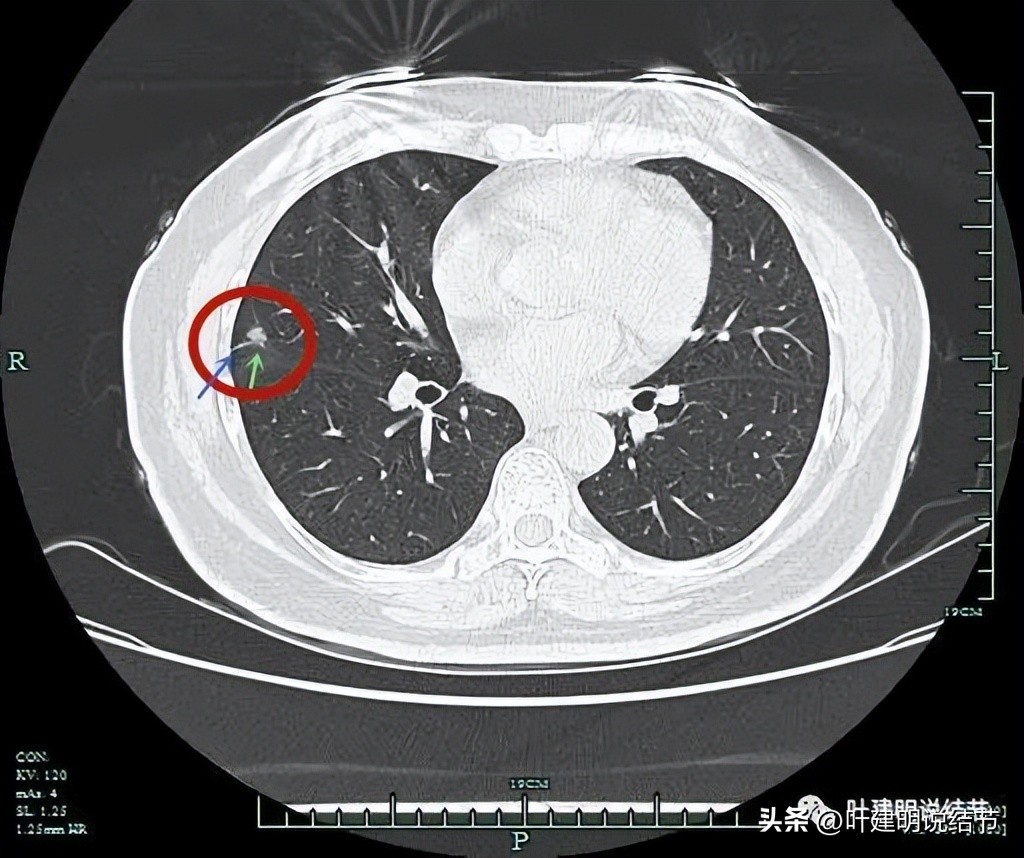 子宫内膜癌术后病灶大于二厘米,子宫内膜癌手术后一年又发现肺癌