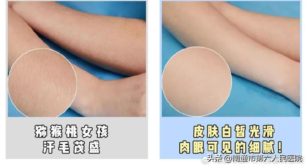 冰点脱毛除唇毛,冰点脱毛能根除体毛吗