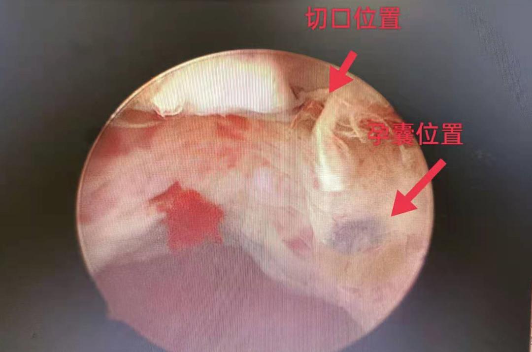 瘢痕妊娠的病因病机,瘢痕妊娠超声诊断标准