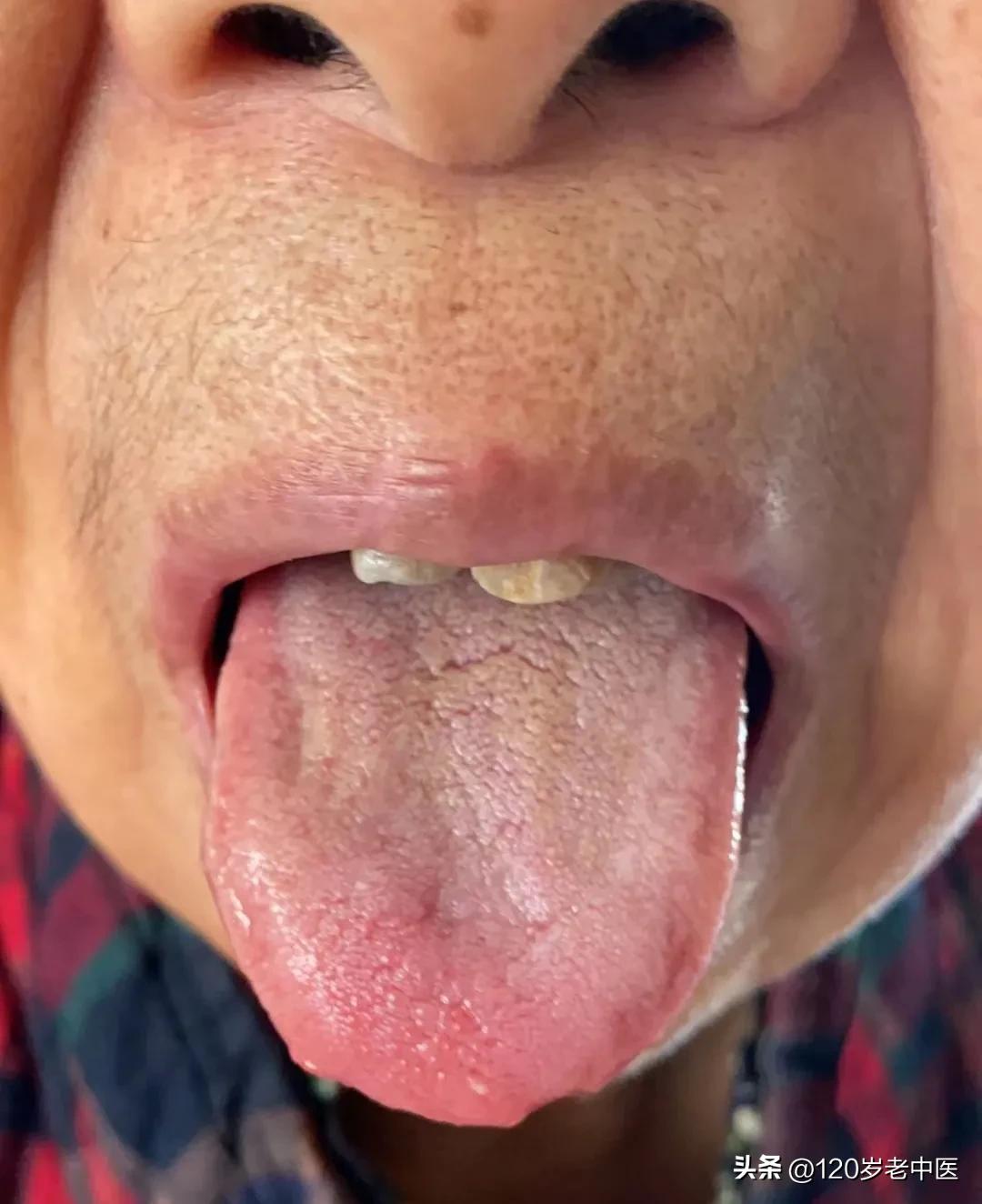 新冠感染后大便干燥可以考虑便宜又好用的防风通圣丸