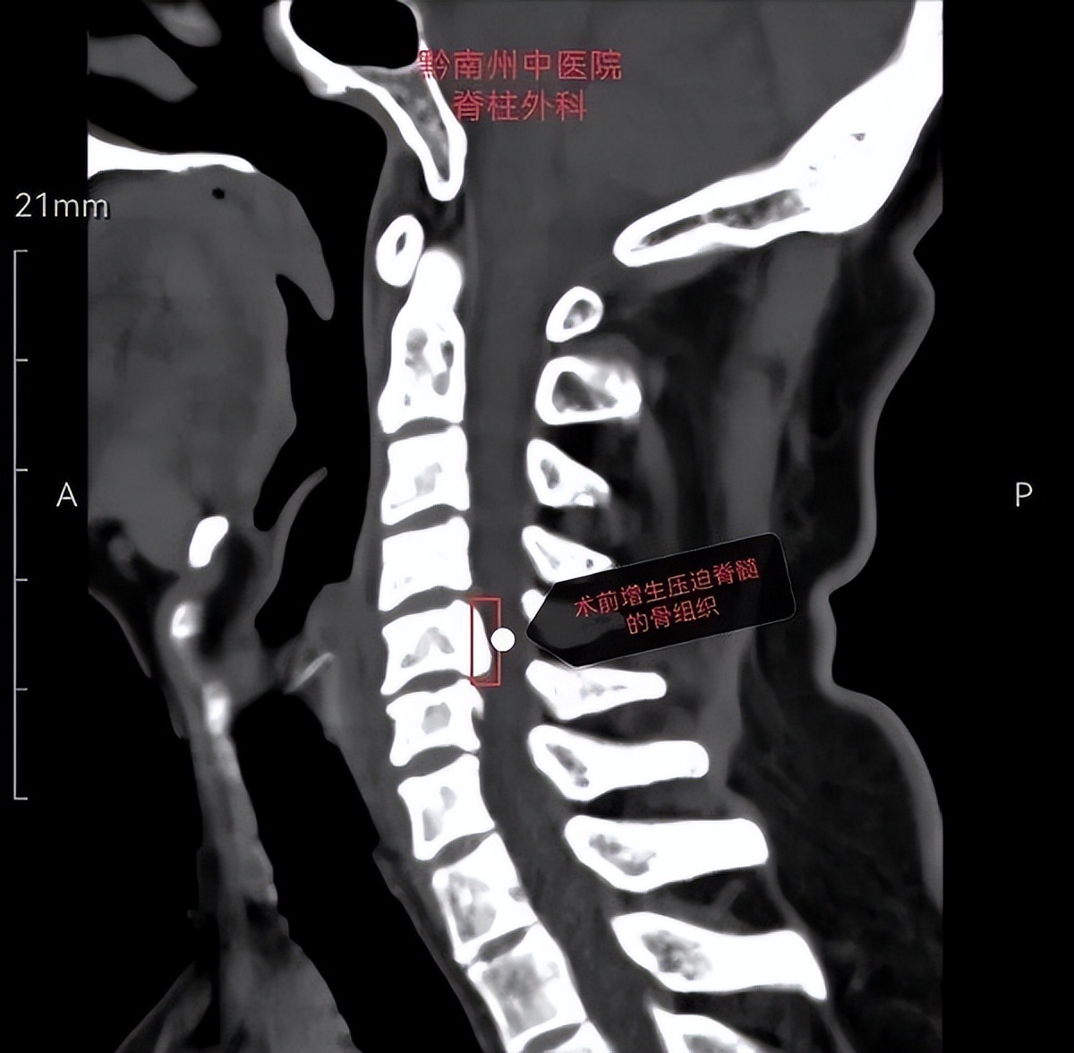 脊柱外科的最新突破,贵州中医二附院脊柱骨科