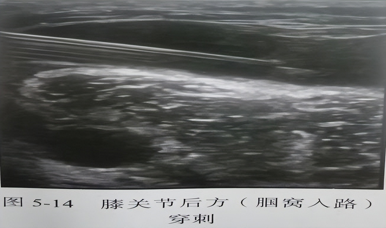 什么是肌骨超声为什么风湿病患者要做肌骨超声？