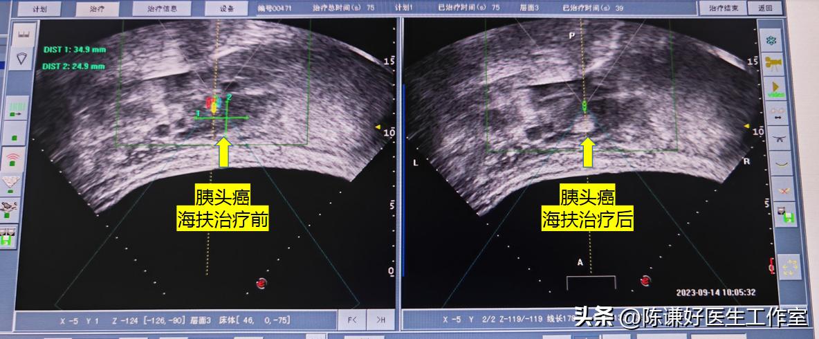 晚期胰腺癌肝转移海扶刀治疗病例（胰腺癌系列19015例）