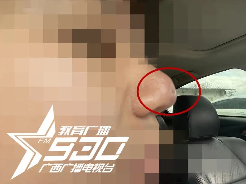 女子花1万隆鼻后山根塌陷,女子花9万多隆鼻