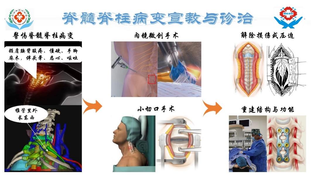 骶管囊肿是肿瘤吗？我该怎么办？