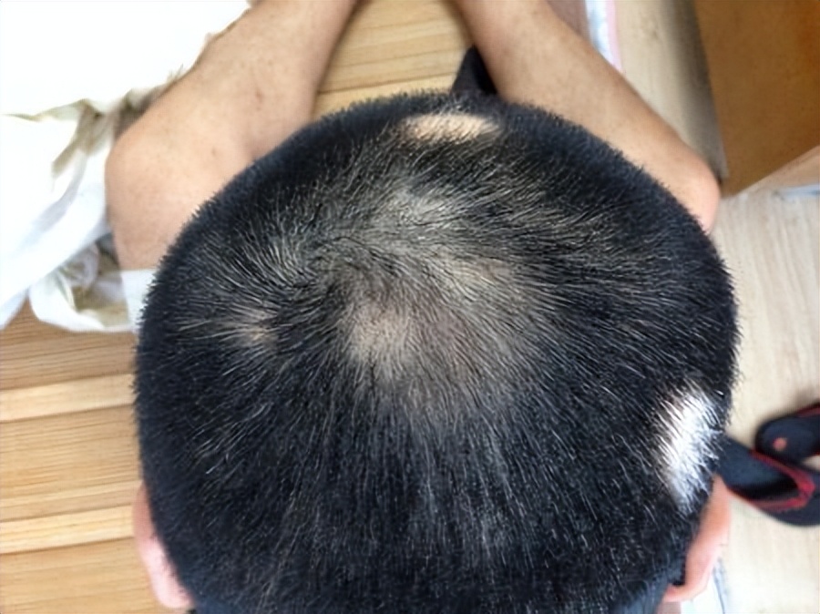 分享一些有什么解决脱发的方法吧,5个方子治脱发