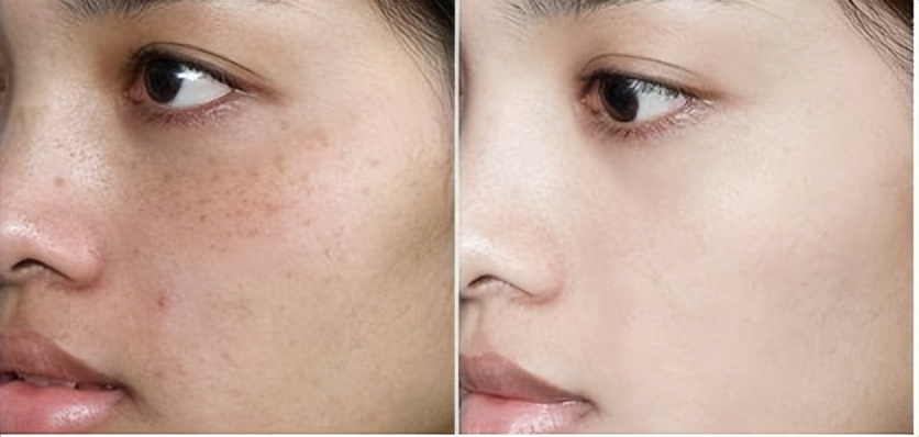 祛斑比较好的护肤产品有哪些品牌,祛斑效果最好的护肤品排名第一