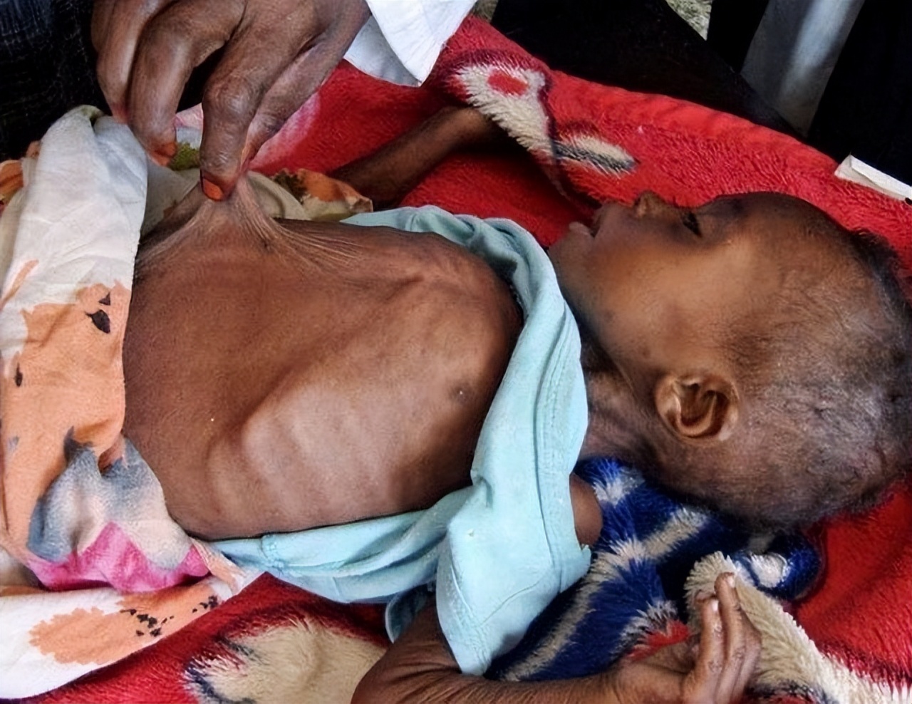 2013年，非洲2岁“巫童”遭父母遗弃，饿得皮包骨，如今还活着吗