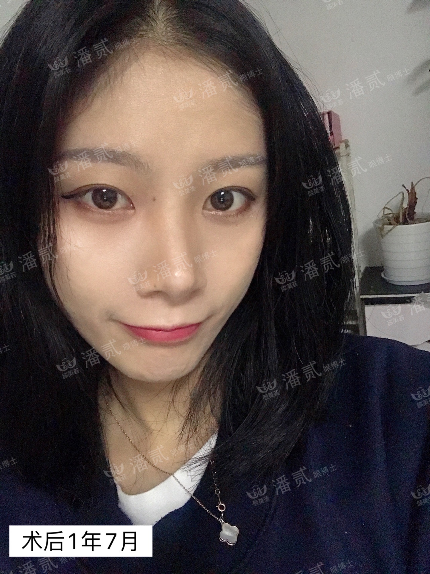 双眼皮贴导致眼皮破了,双眼皮贴导致眼皮严重下垂恢复