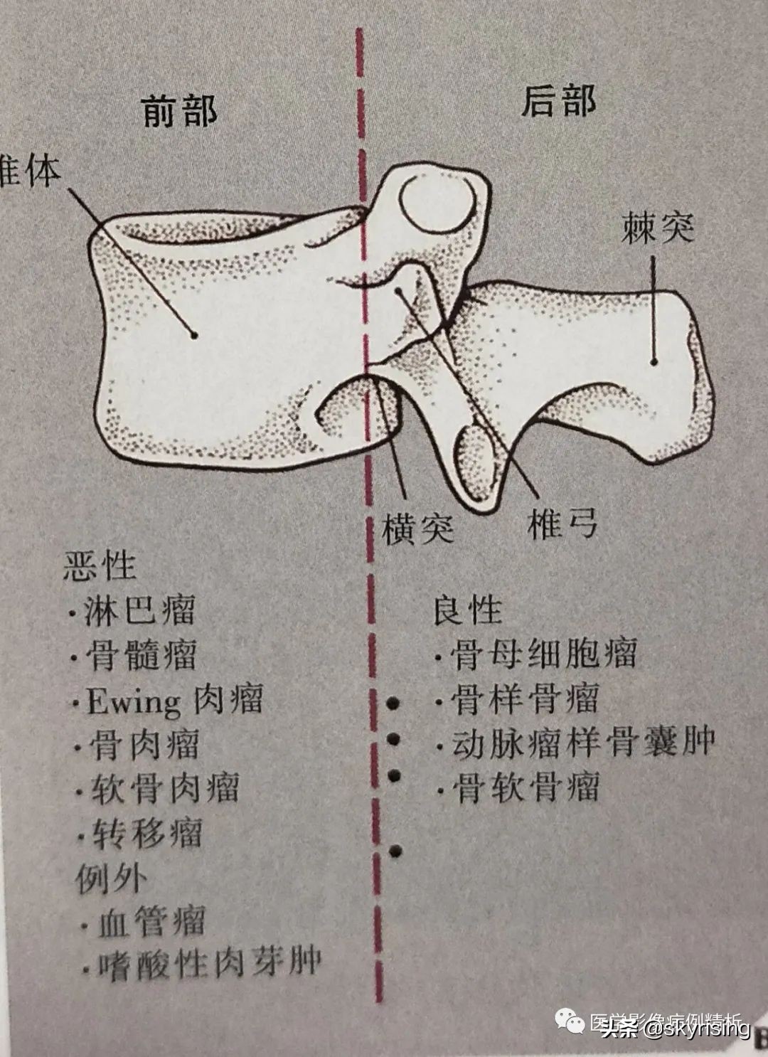 脊索瘤造成骨质破坏严重吗,多发椎体骨质破坏考虑转移瘤