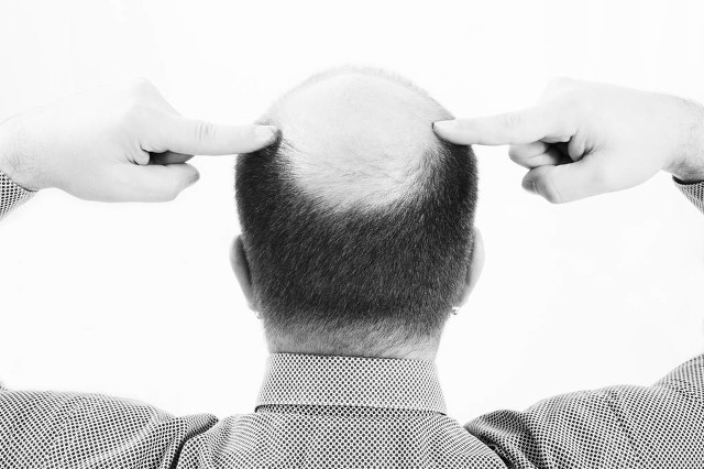 中医治疗脱发枯黄细软,脱发补气血食疗方法