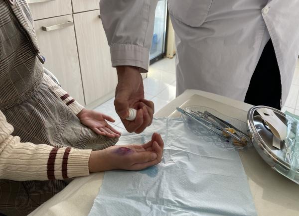 小丫吃火锅烫伤家人乱用药加重伤情