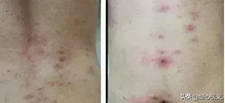 疥疮是什么病的症状啊,疥疮被传染的最初症状