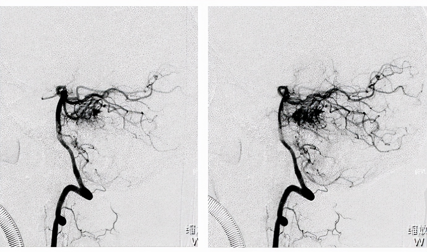 新生儿身上有肿块，当心动静脉畸形